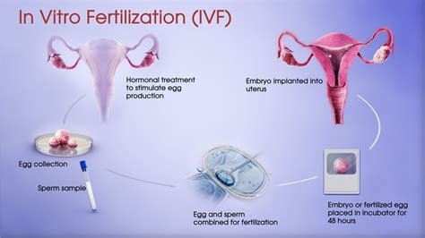 Aetna İn Vitro Fertilization